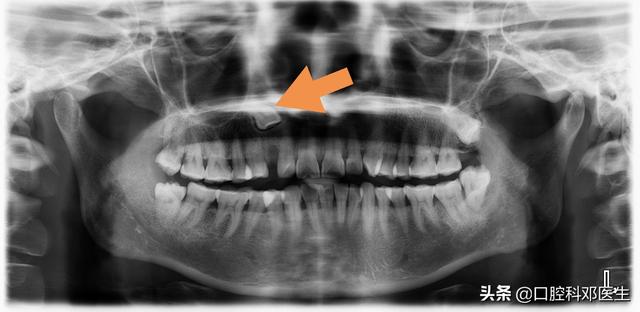 由于外伤致牙齿断裂,特别是牙根断裂,牙齿完全脱位,这样的牙齿