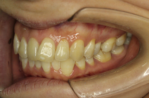 患者牙齿拥挤不齐,牙弓狭窄,嘴突,患者对自己侧貌不满意矫治时间:24个