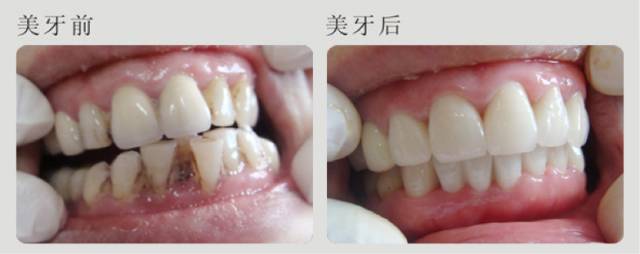 羡慕刘涛一口白牙?先看看她“美容冠”血泪史…