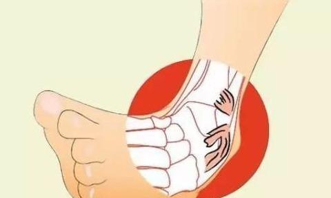 韧带拉伤怎么办呢?日常要怎样预防