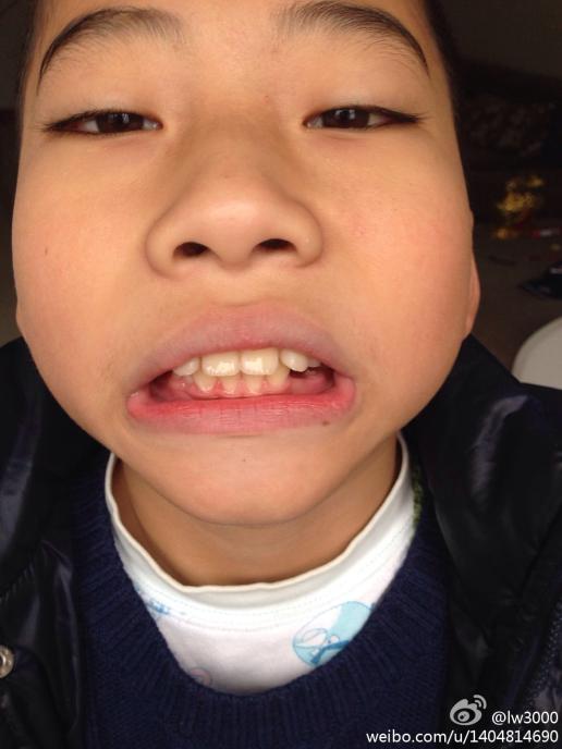 我家小朋友10岁了,上下各长了4颗牙,上面的有点龅牙,去了县