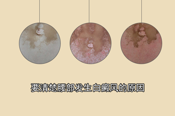 常见的腰部白斑诱发原因1,摩擦导致:白癜风疾病虽然诱发因素比较多