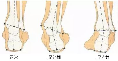 偏癱康復乾貨:足內翻與足外翻有何區別?康復治療怎麼做才有效?