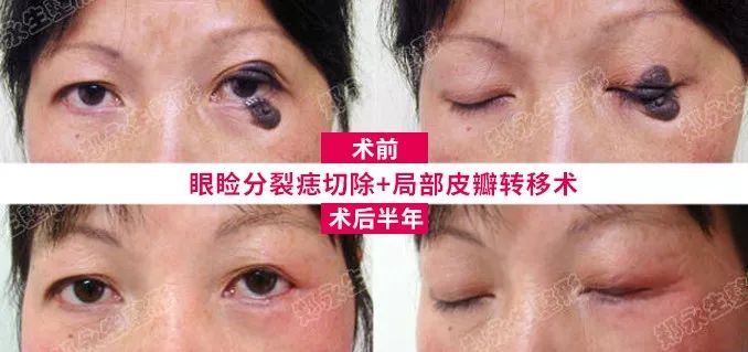 这位女士术前同样存在眼睑分裂痣的情况,由于分裂痣去除会涉及到重睑