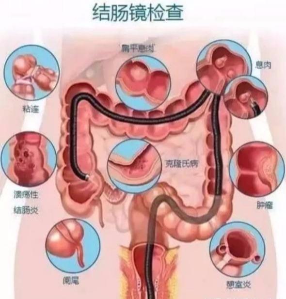 大肠癌肚子图片
