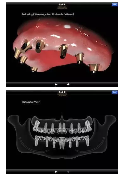 4颗种植体,卡杆固位,可摘覆盖义齿2
