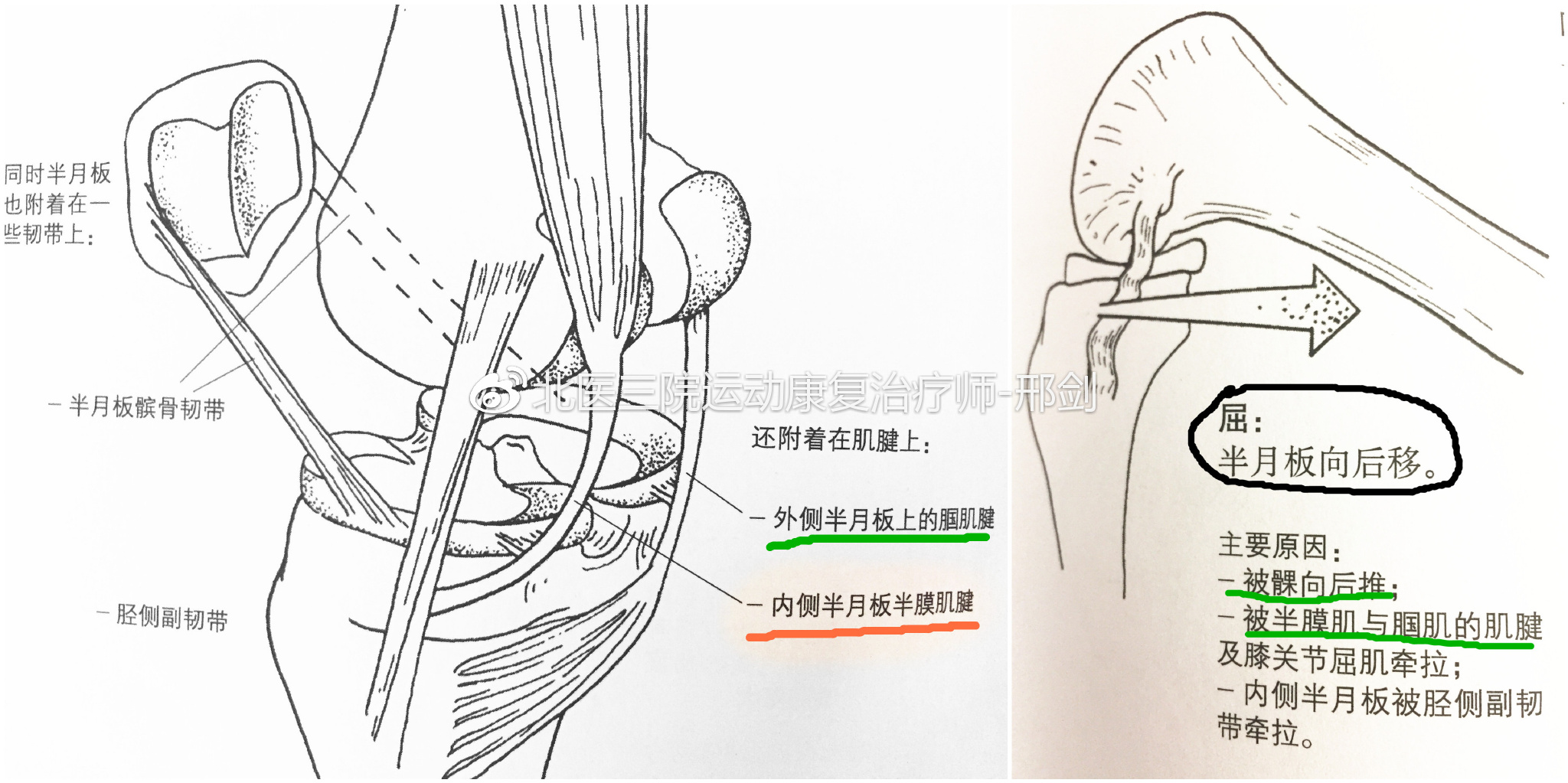 總結:因半月板解剖和功能的特殊性,縫合術後rom和wb進階要放緩:這取決