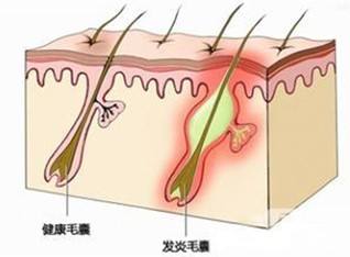 毛囊炎,癤,癰,皮脂腺囊腫怎麼區分?