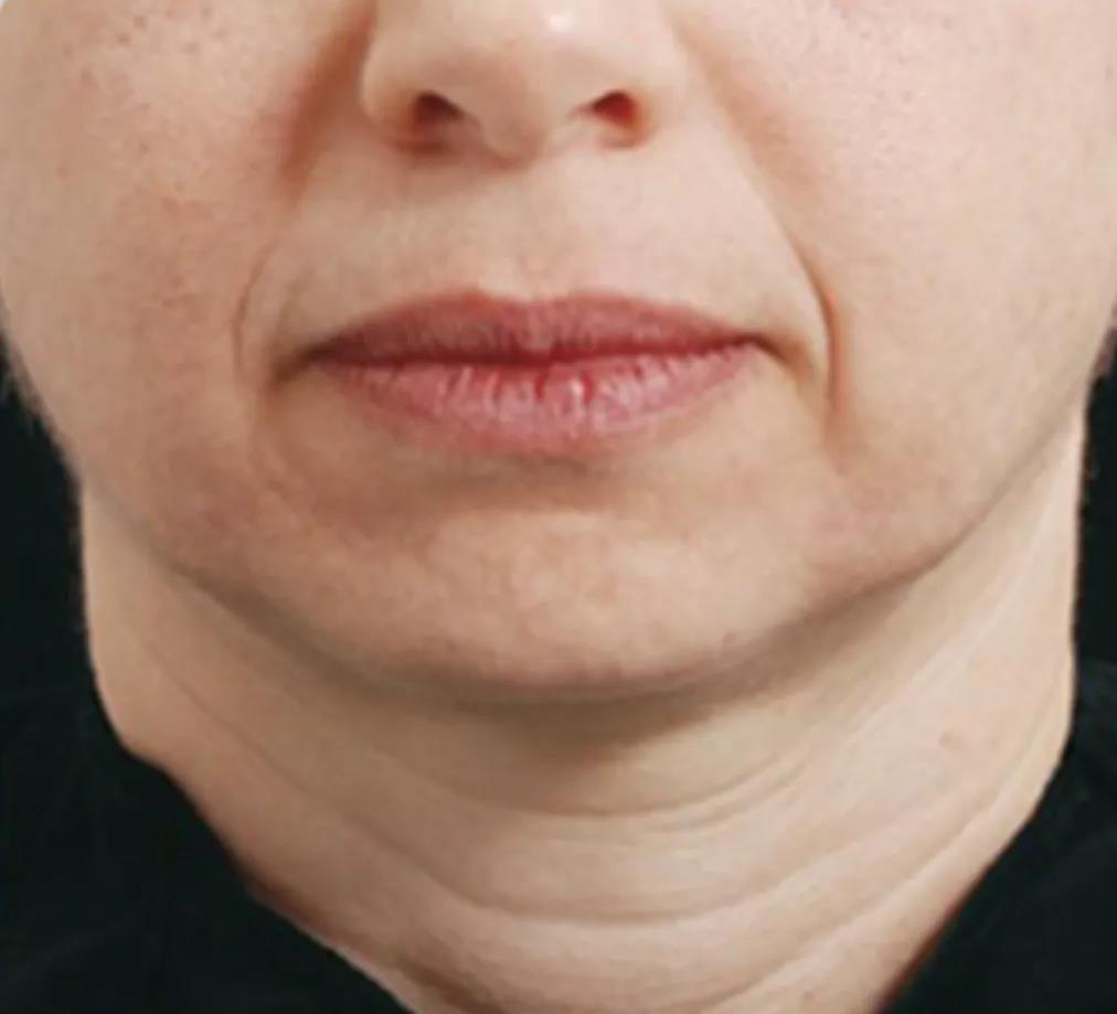 如何干掉显老的表情纹?这招最适合爱笑的女孩