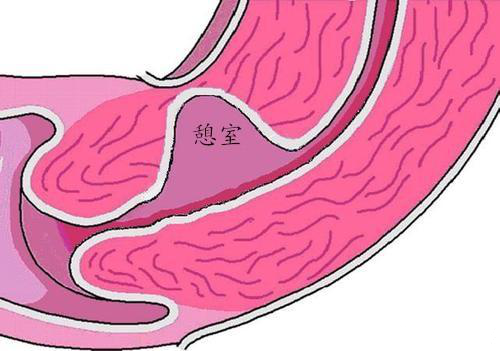 患有子宫瘢痕憩室的女性有一部分人可能都没啥症状,不必治疗,而另一