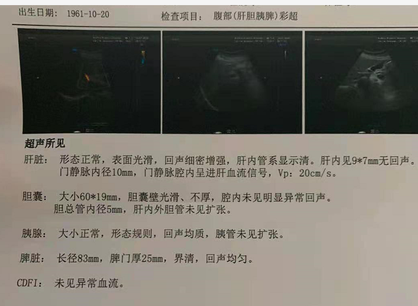 【經典問答】ct查出胰頭鈣化灶是胰腺癌嗎?