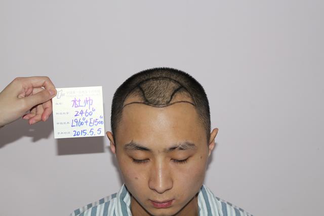 90后杜先生三级脱发5个月后是这样