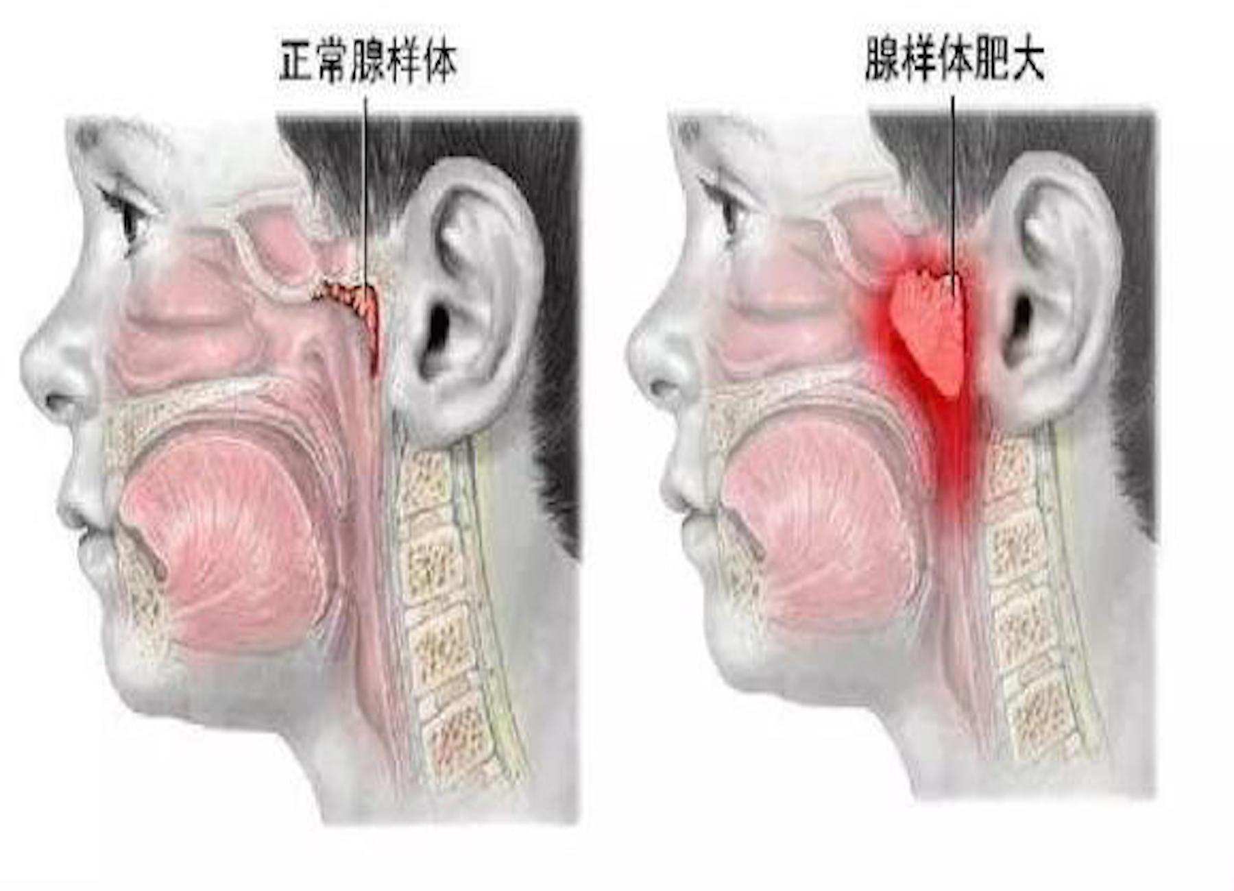 腺样体也叫咽扁桃体或增殖体,位于鼻咽部顶部与咽后壁处,属于淋巴组织