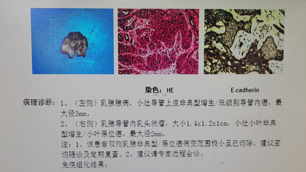 手术病理新看点四:乳腺小叶原位癌是乳腺癌吗