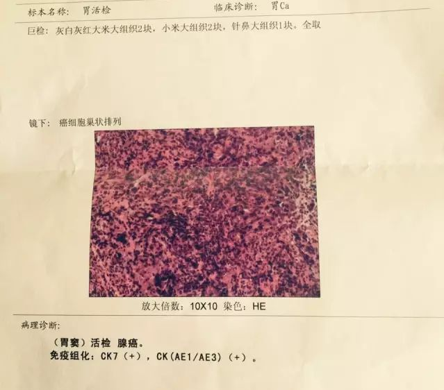 立马在当地市医院做胃镜 活检,确诊癌症晚期—胃窦癌伴肝多发转移