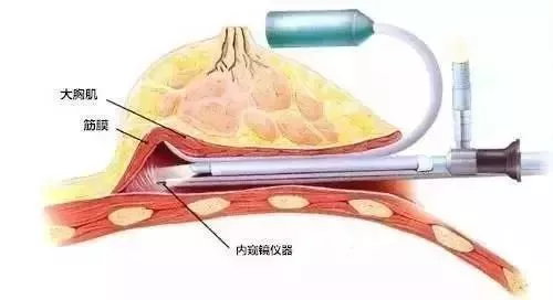 半月皱襞变大