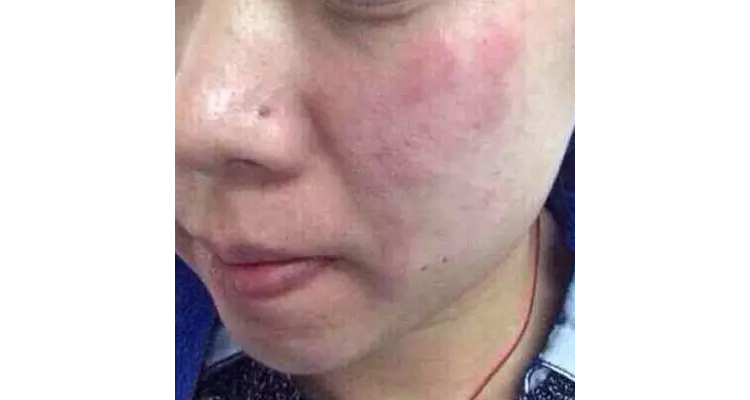 1%的面膜中添加了糖皮质激素.天津市泰达医院李青