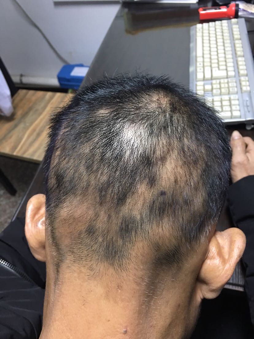 较大面积斑秃治疗中期疗效分析