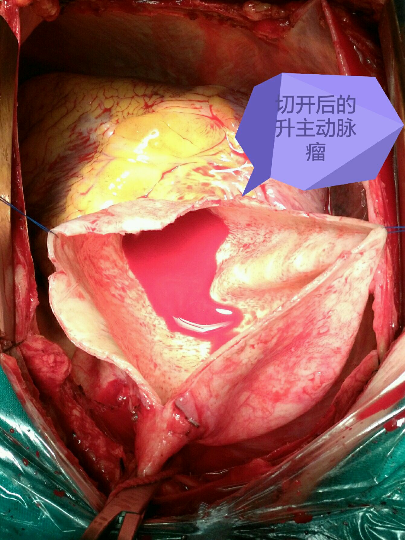 巨大升主动脉瘤1例