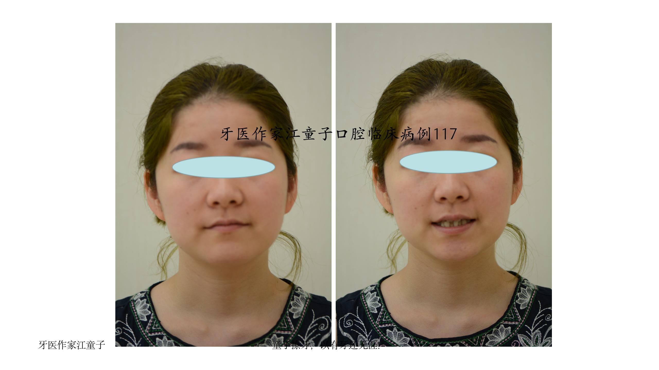 《邻面去釉(片切)在牙齿矫正中的运用》