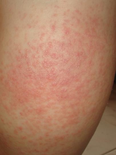 热性荨麻疹症状图片图片