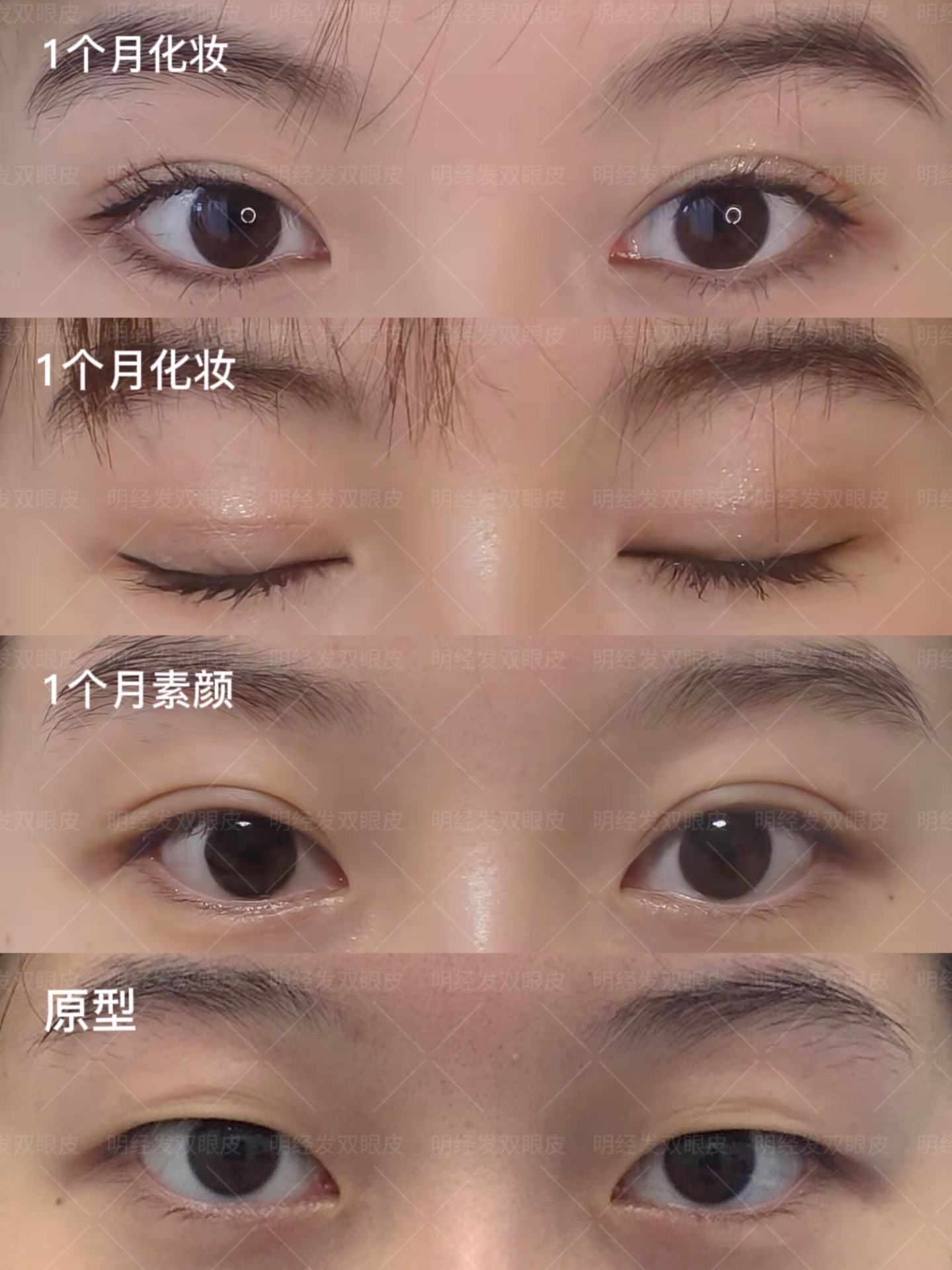 青岛5S双眼皮真实案例分享，术前术后效果对比 - 青岛新闻网