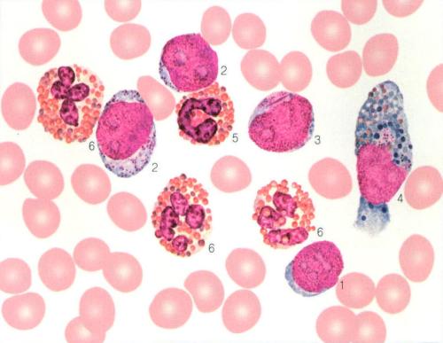 本病巨核细胞增殖不仅在骨髓内,而且可累及骨髓外组织,肝,脾等组织内