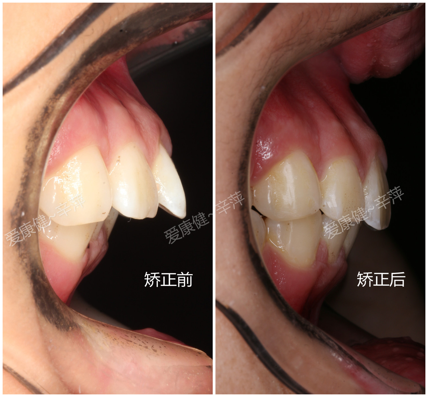 骨突一定要做正颌手术吗?-辛萍主治医师-爱问医生