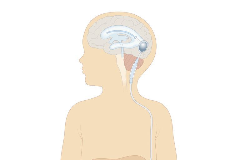 腦積水治療腦脊液指標對腦室腹腔分流術的影響