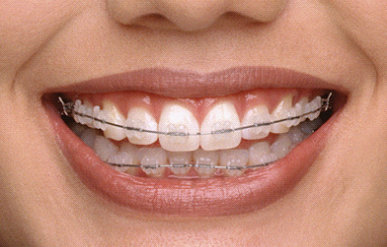 兔牙,什么时候开始矫正?