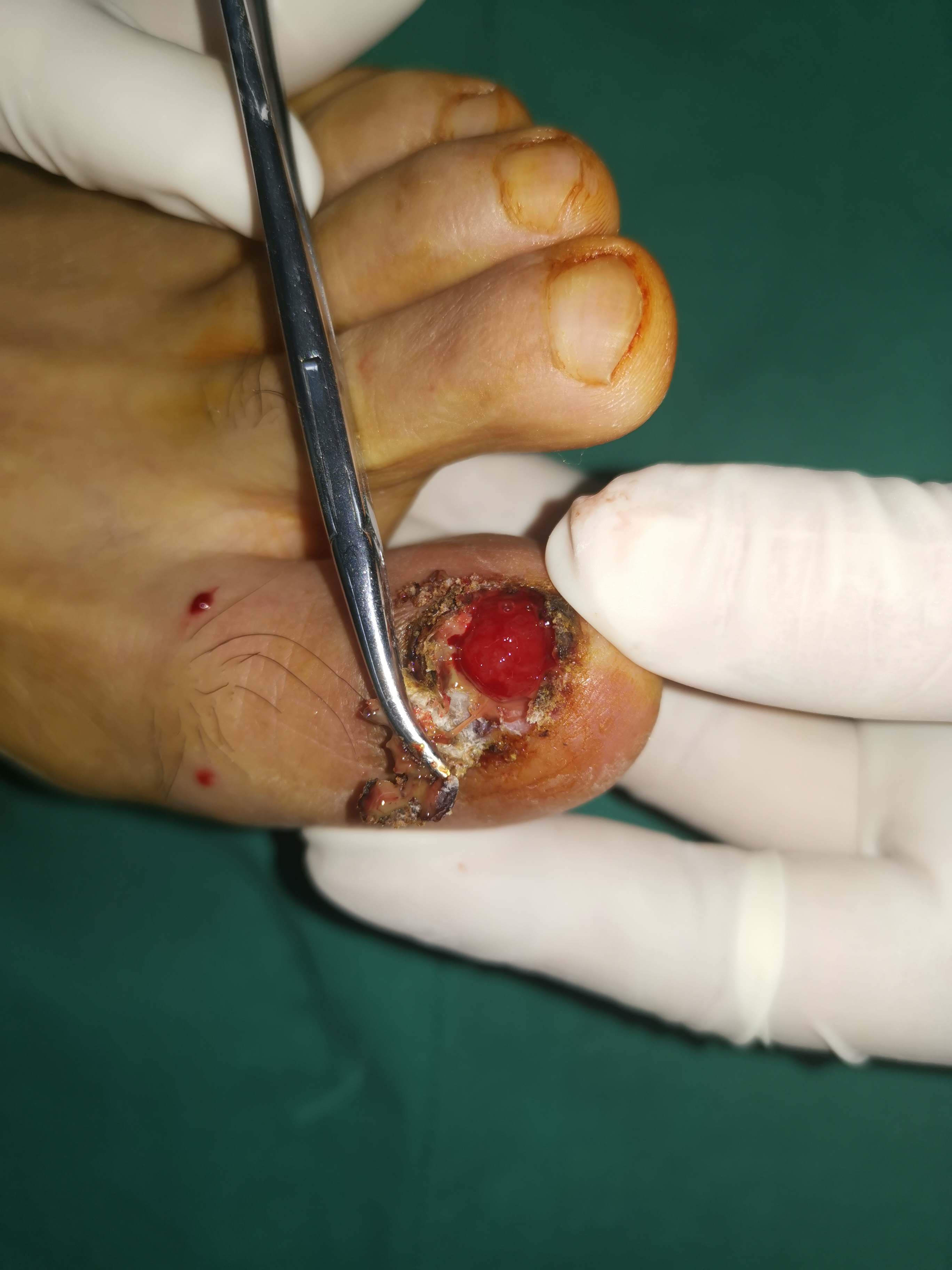 嵌甲别轻易拔甲