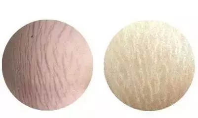 即使瘦下去,因为皮肤的弹性纤维断裂后,一般是不会自主修复的;并且吃