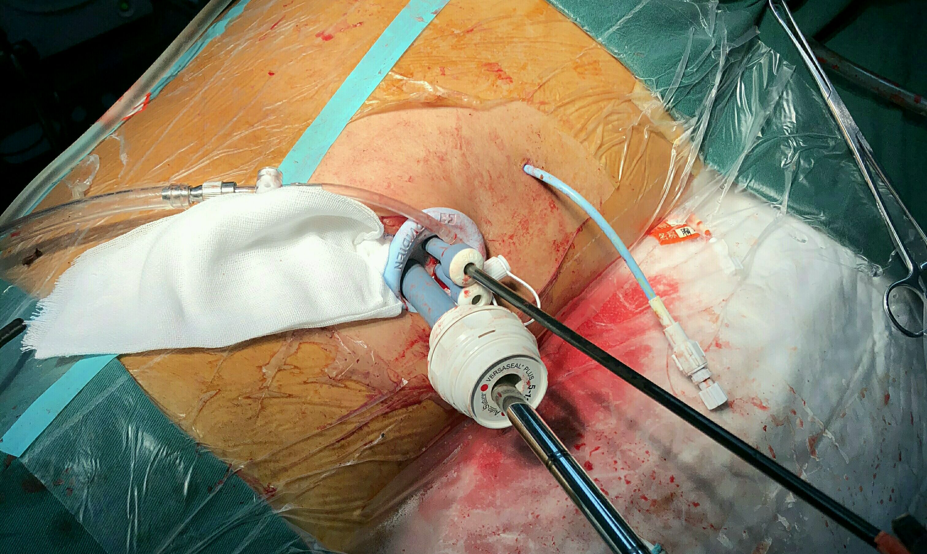 胰腺炎手术刀口图片图片