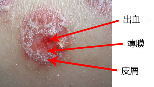 一般带"癣"字的疾病,是由真菌或细菌感染引起的,很难治,还会传染,比如