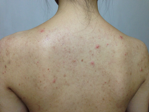 背部痘痘这样治6招助你美翻天