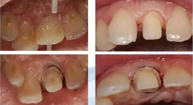 前門牙牙髓炎根管治療冠修復1例