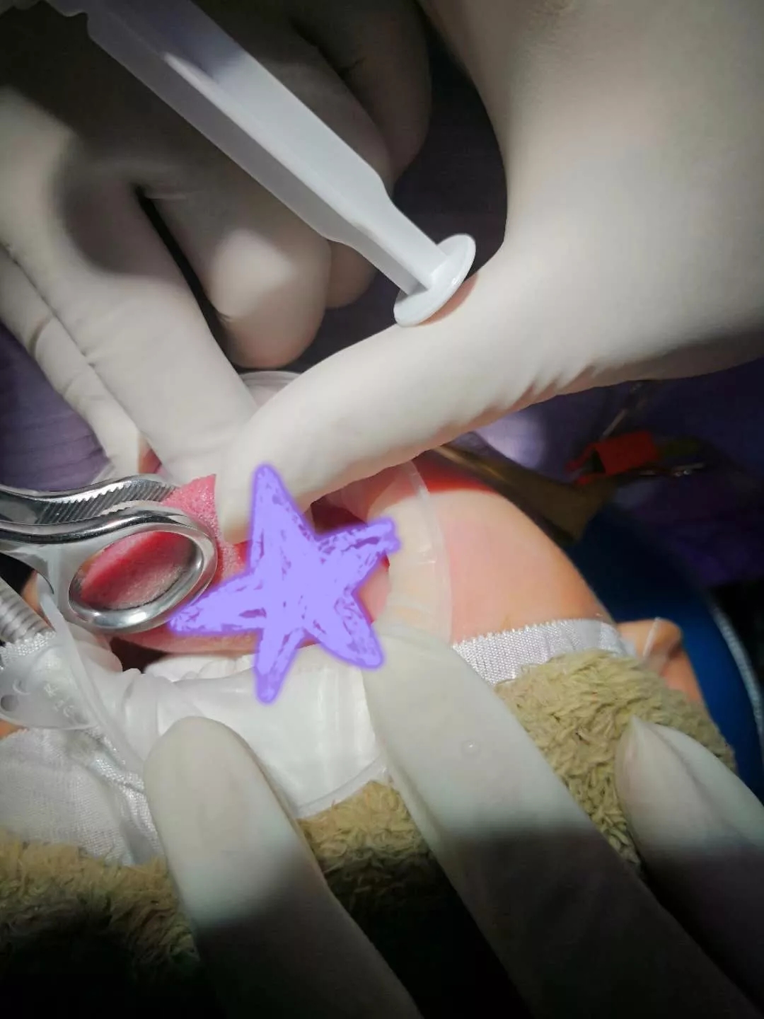 【真人案例】成功救助断舌男童—守护口腔健康,我们与你同在!