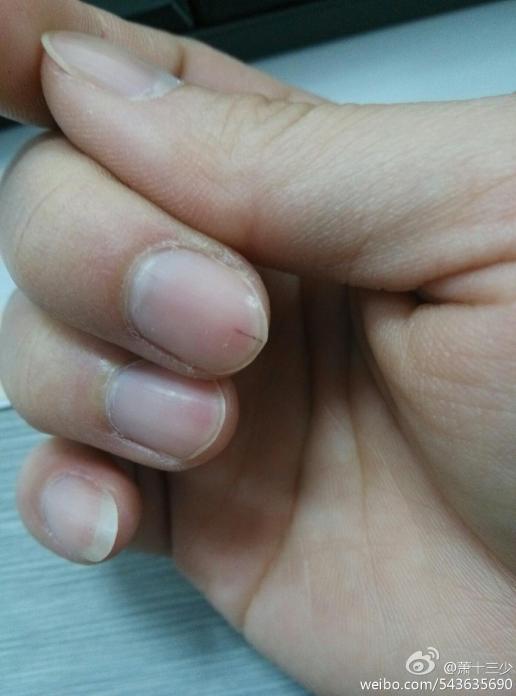 指甲盖里的血丝是怎么回事啊