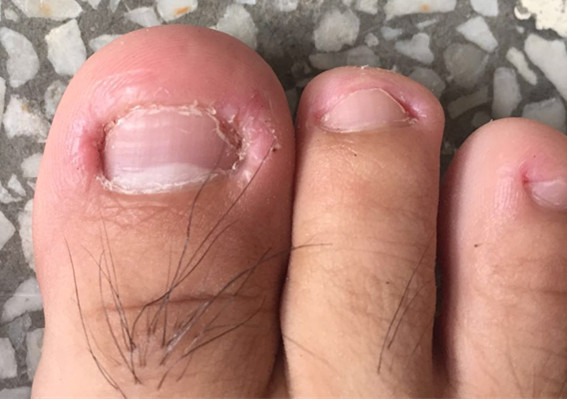 致皱襞损伤,伴疼痛,继发感染,甲皱褶组织红肿,重者肉芽组织增生