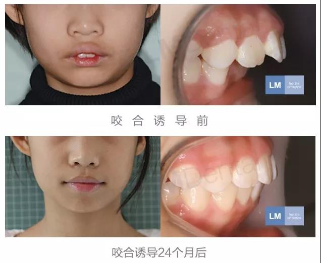 那些做了咬合诱导矫正的宝宝后来都怎么样了效果如何