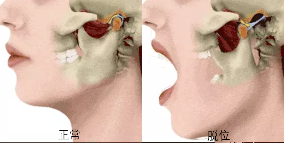 颞下颌关节脱位复位图图片