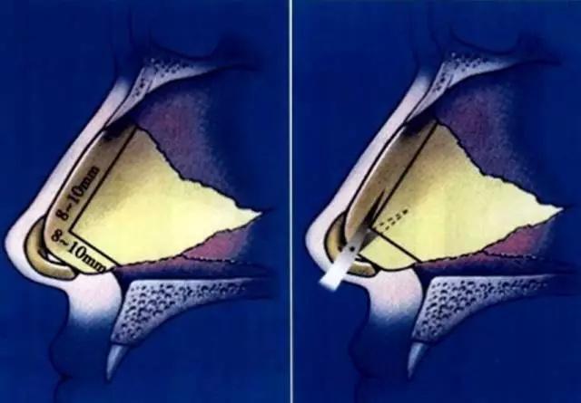 ▼鼻中隔軟骨取材範圍