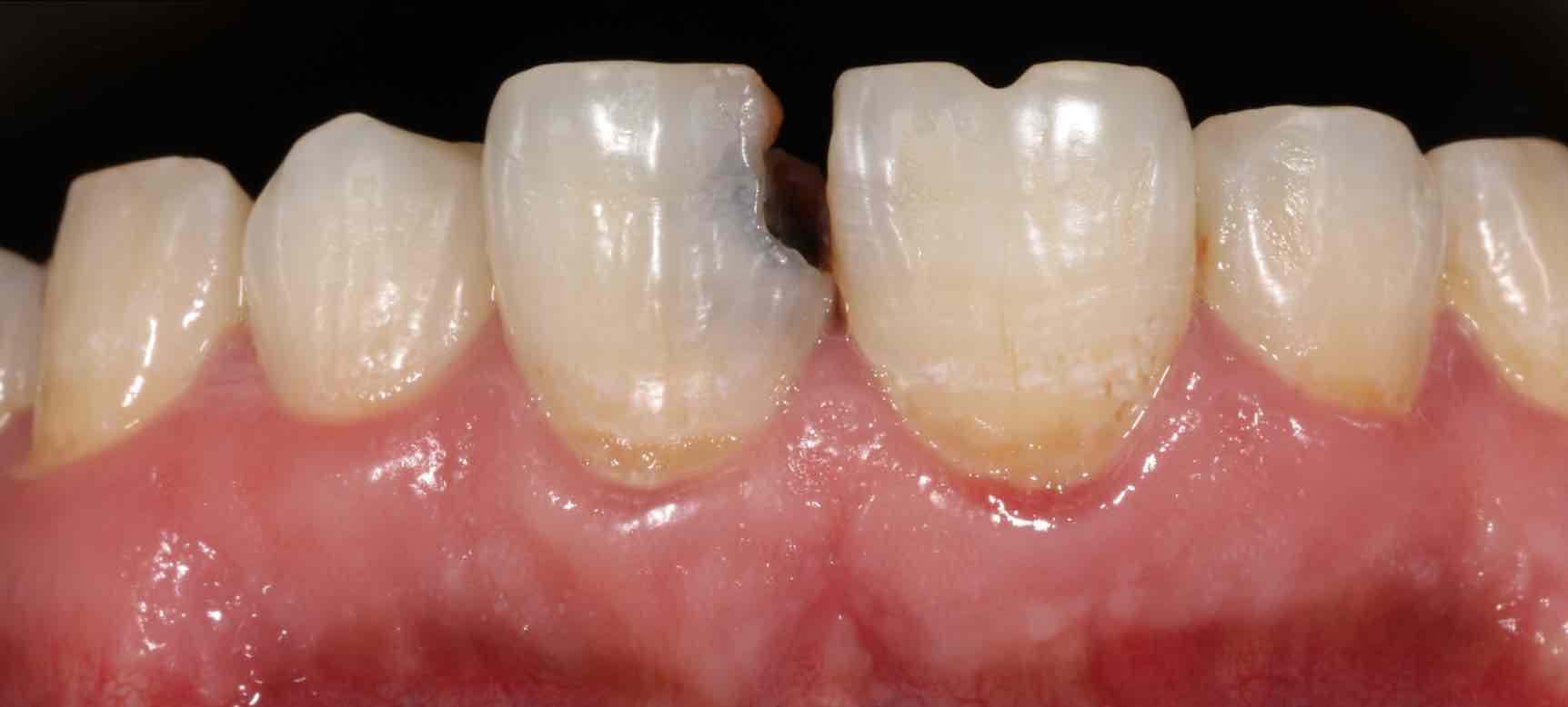 前牙树脂直接修复