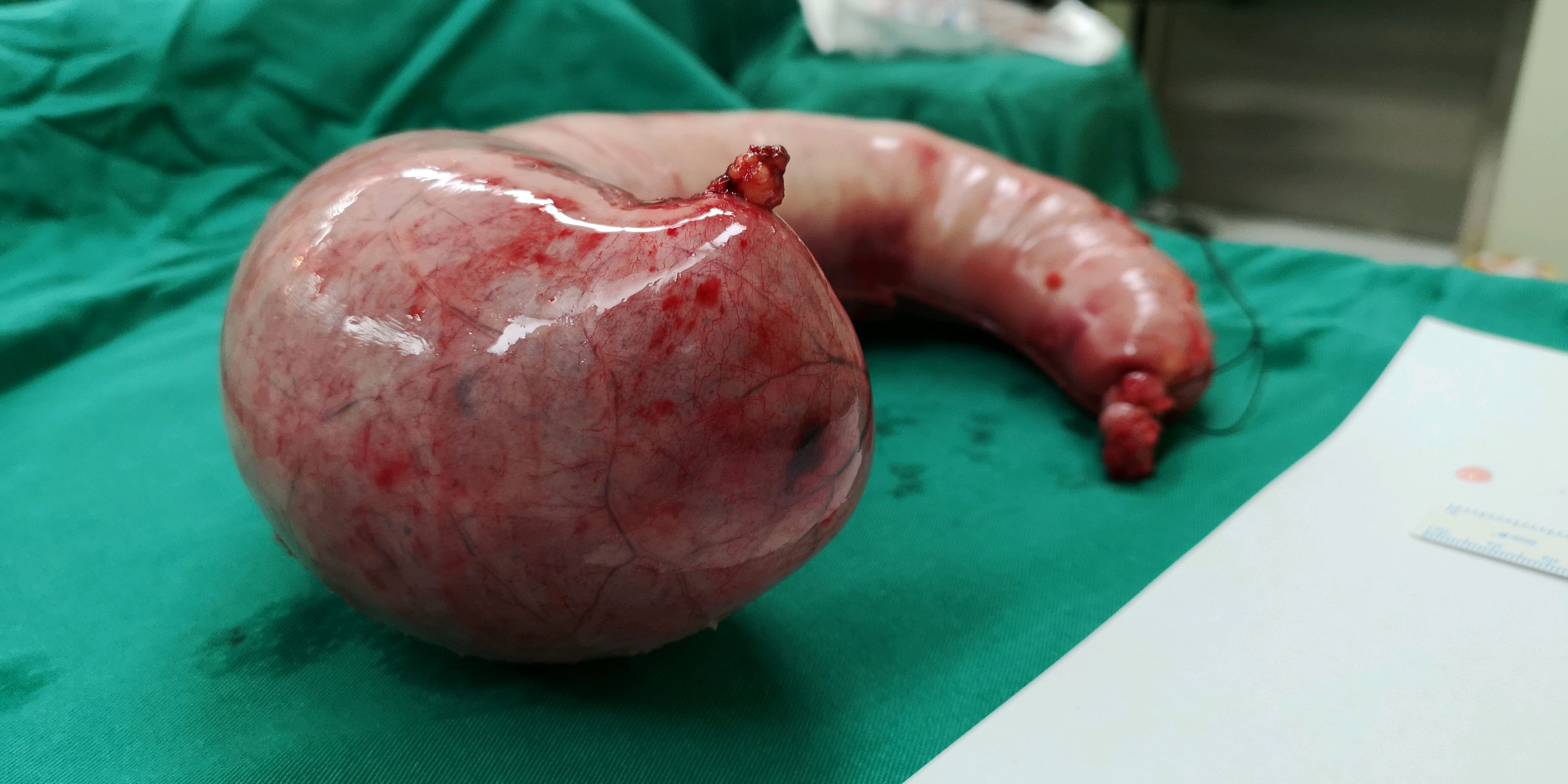 袖状胃空肠旷置手术图片
