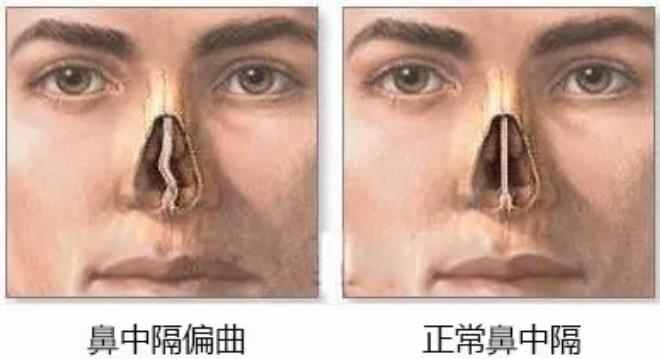 鼻中隔偏曲到底需不需要手术?