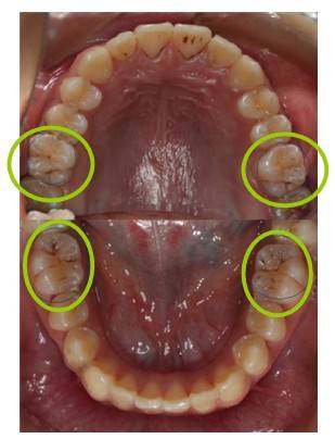 图二 双排牙(内侧—舌侧的牙齿为恒牙,外侧—唇侧的牙齿为滞留乳牙)图