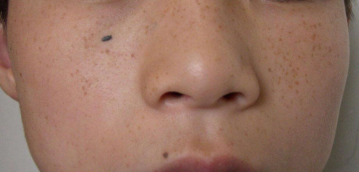 黄褐斑需要与雀斑﹑黑变病﹑颧部褐青色痣,色素性化妆品皮炎等面部