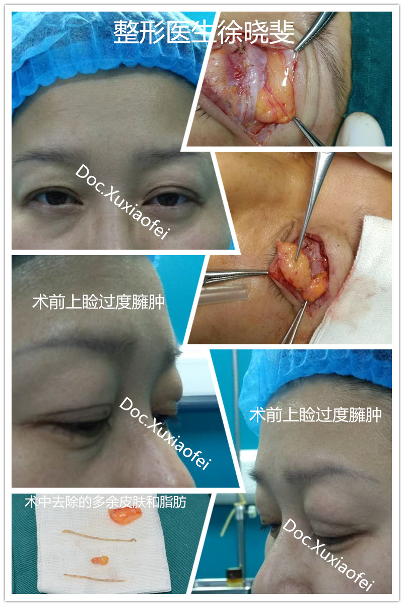 上睑脂肪该拿你怎么办