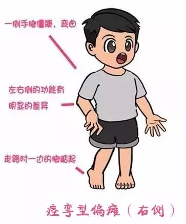 小儿脑瘫,你想要了解的都在这里!