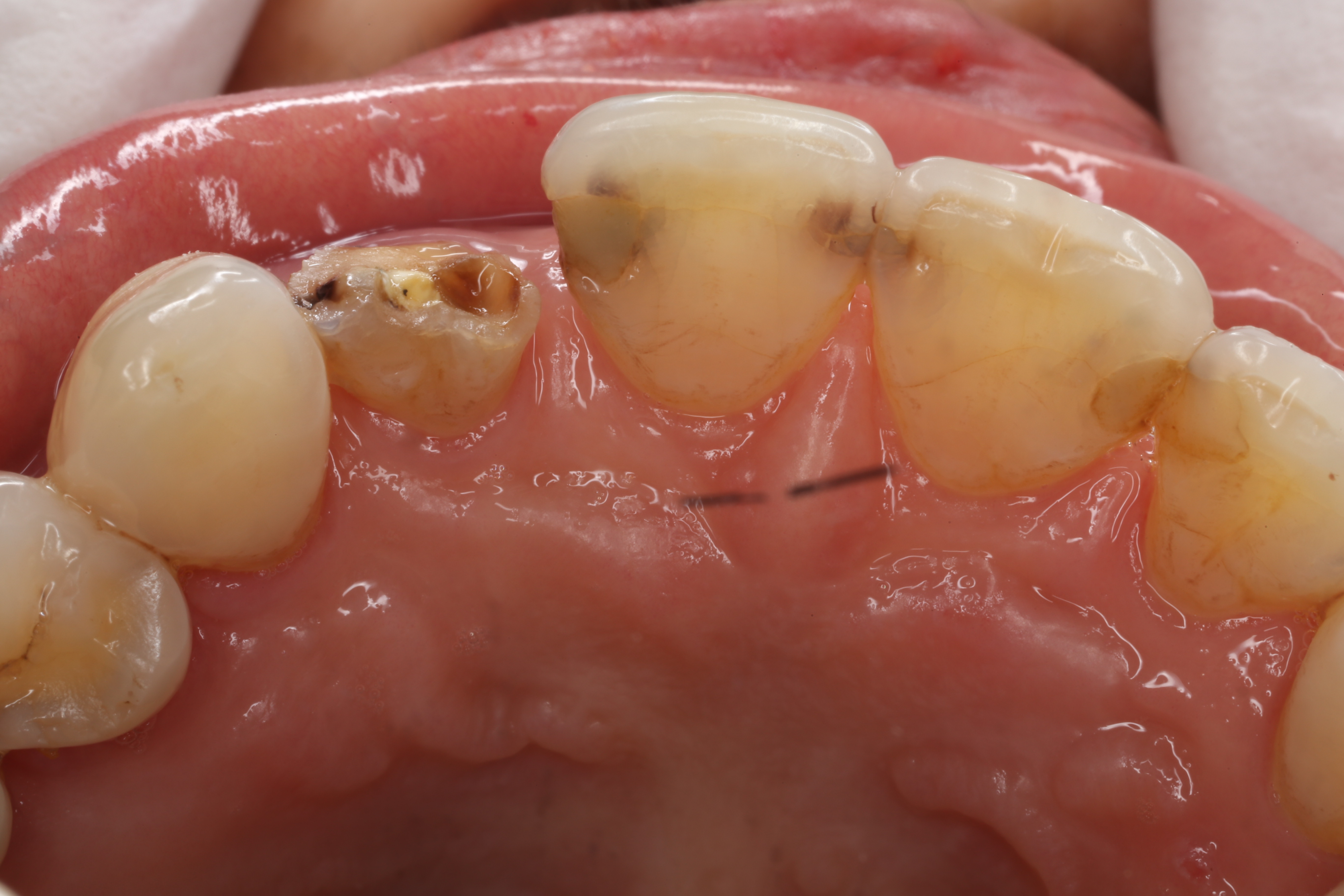 即刻修复瓷睿刻全瓷前牙美学修复案例